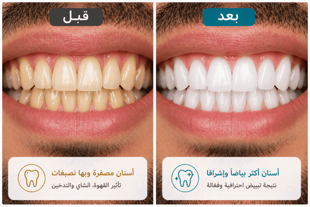 صورة مقارنة قبل وبعد تبييض الأسنان تظهر أسنان مصفرة قبل العلاج وأسنان أكثر بياضًا بعد التبييض