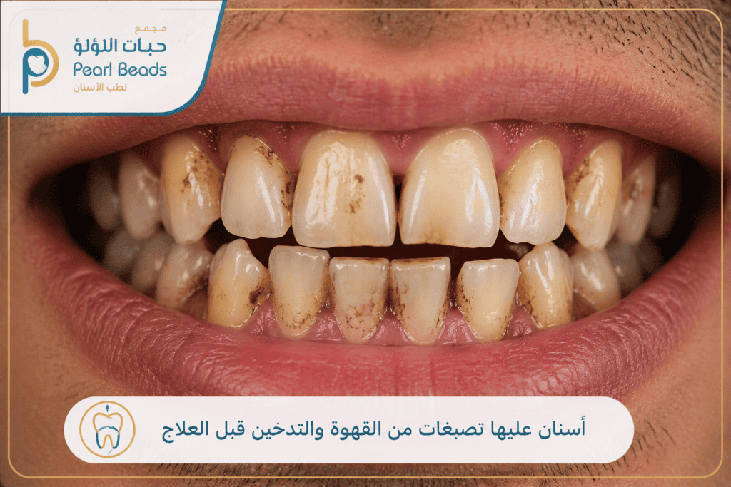 صورة مقربة لأسنان عليها تصبغات من القهوة والتدخين قبل العلاج مع شعار مجمع حبات اللؤلؤ لطب الأسنان