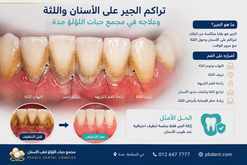 صورة توضح تراكم الجير حول الأسنان بالقرب من اللثة وتأثيره على صحة الفم والحاجة إلى تنظيف الأسنان الاحترافي